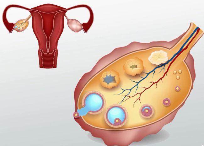 多囊卵巢食疗秘方_怎样保养卵巢和子宫_卵巢保养秘方