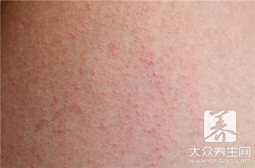 中医治疗湿疹的方法(1)