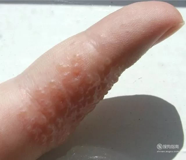 手癣偏方_手癣偏方简单有效快速_手癣偏方大全