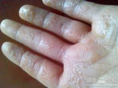 手癣偏方_手癣偏方简单有效快速_手癣偏方大全