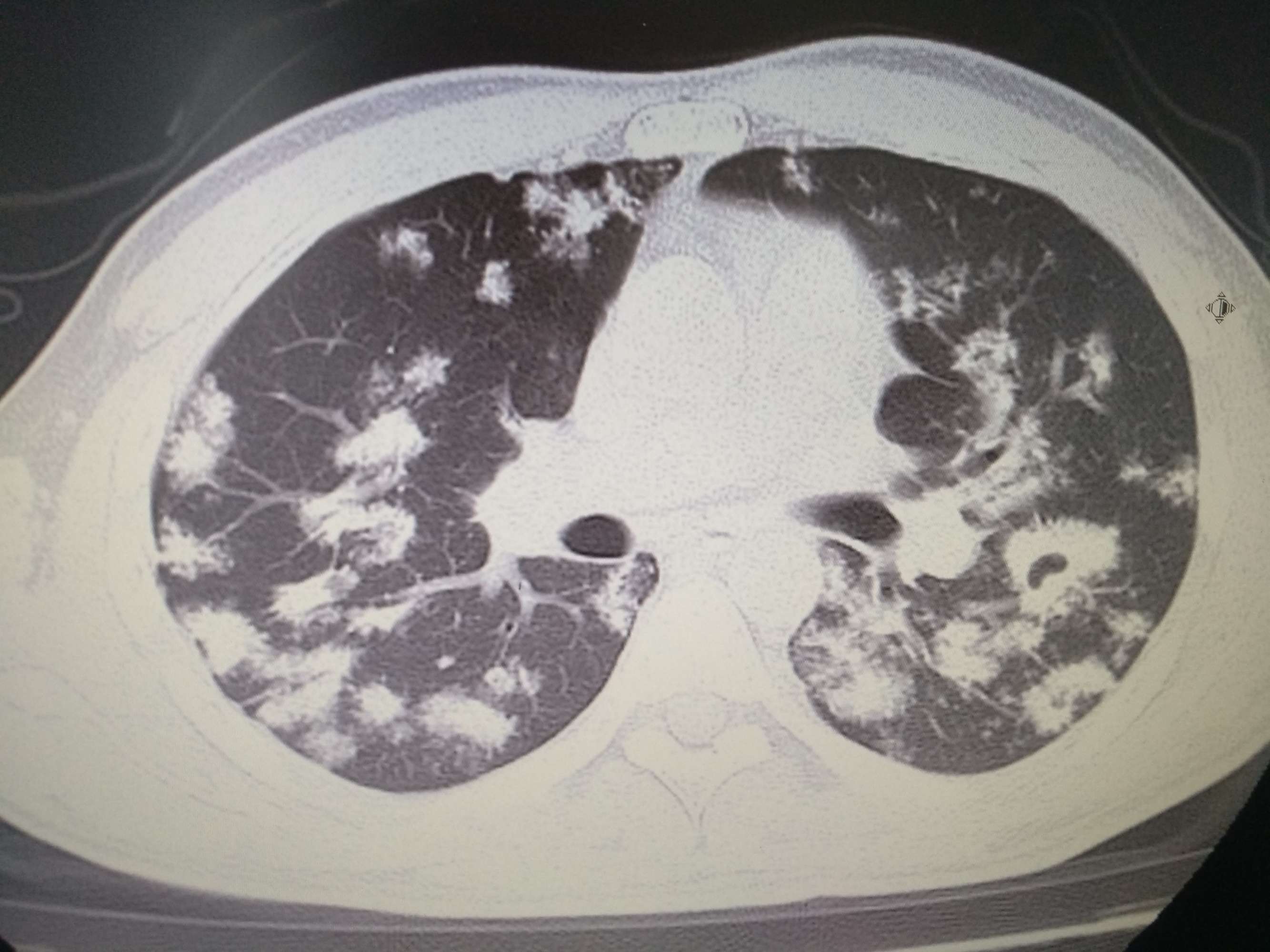 继发型肺结核图片