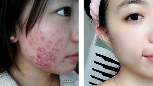 消除痘痘的偏方_消除痘痘_怎么消除痘痘和痘印