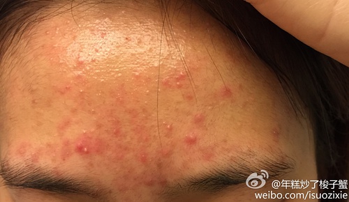 什么东西摸人脸上能起痘痘(有什麽东西摸了就能祛痘) 治疗痘坑痘印哪里好_治疗痘坑痘印的中药配方_痘印痘坑怎么办