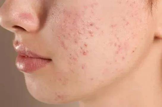 什么东西摸人脸上能起痘痘(有什麽东西摸了就能祛痘) 痘印痘坑怎么办_治疗痘坑痘印哪里好_治疗痘坑痘印的中药配方