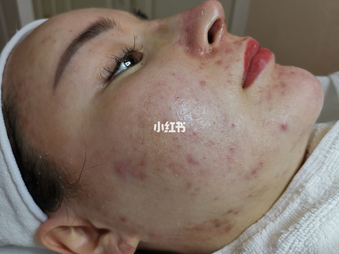 什么东西摸人脸上能起痘痘(有什麽东西摸了就能祛痘) 治疗痘坑痘印哪里好_痘印痘坑怎么办_治疗痘坑痘印的中药配方