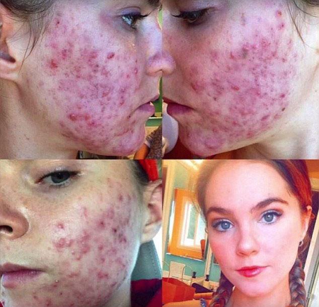 什么东西摸人脸上能起痘痘(有什麽东西摸了就能祛痘) 痘印痘坑怎么办_治疗痘坑痘印的中药配方_治疗痘坑痘印哪里好