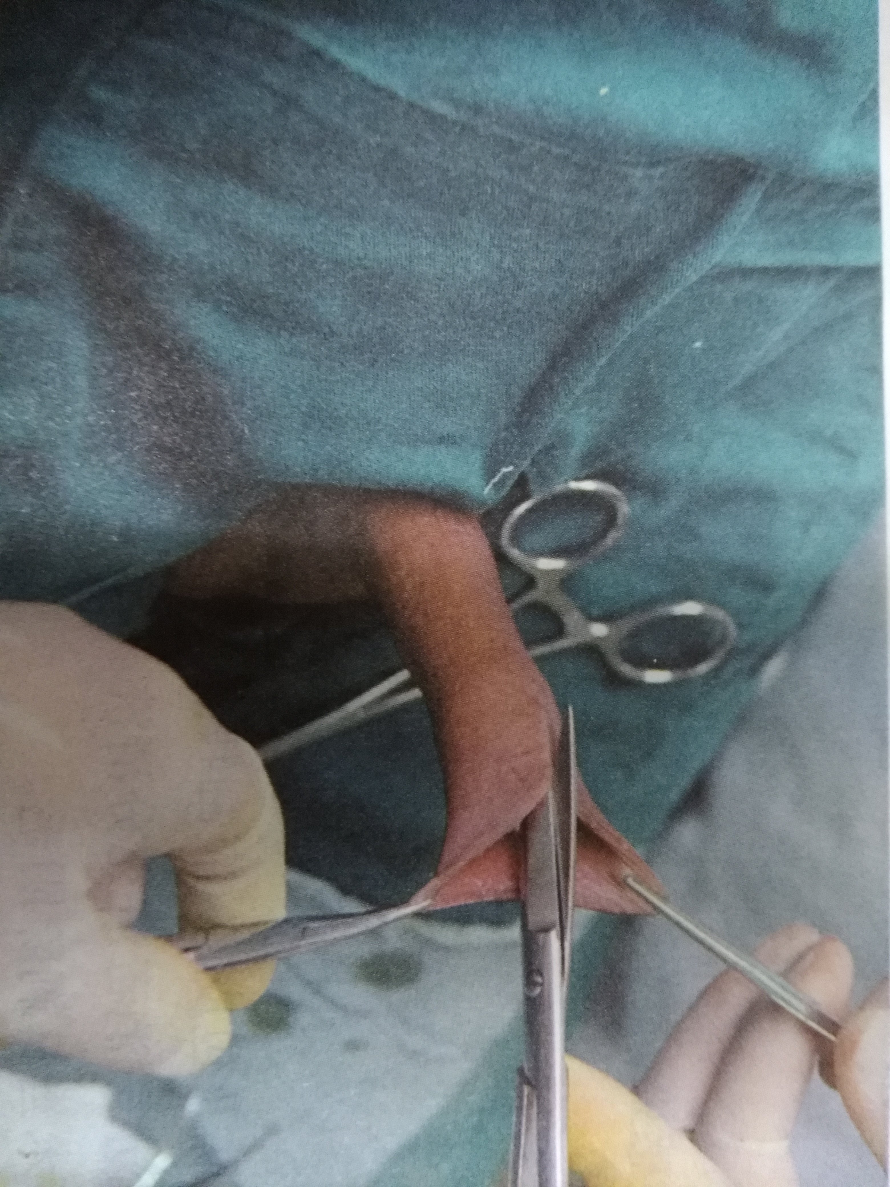 包皮手术后多久可以同房_包皮手术取环后_包皮淋巴管炎可以手术切除吗