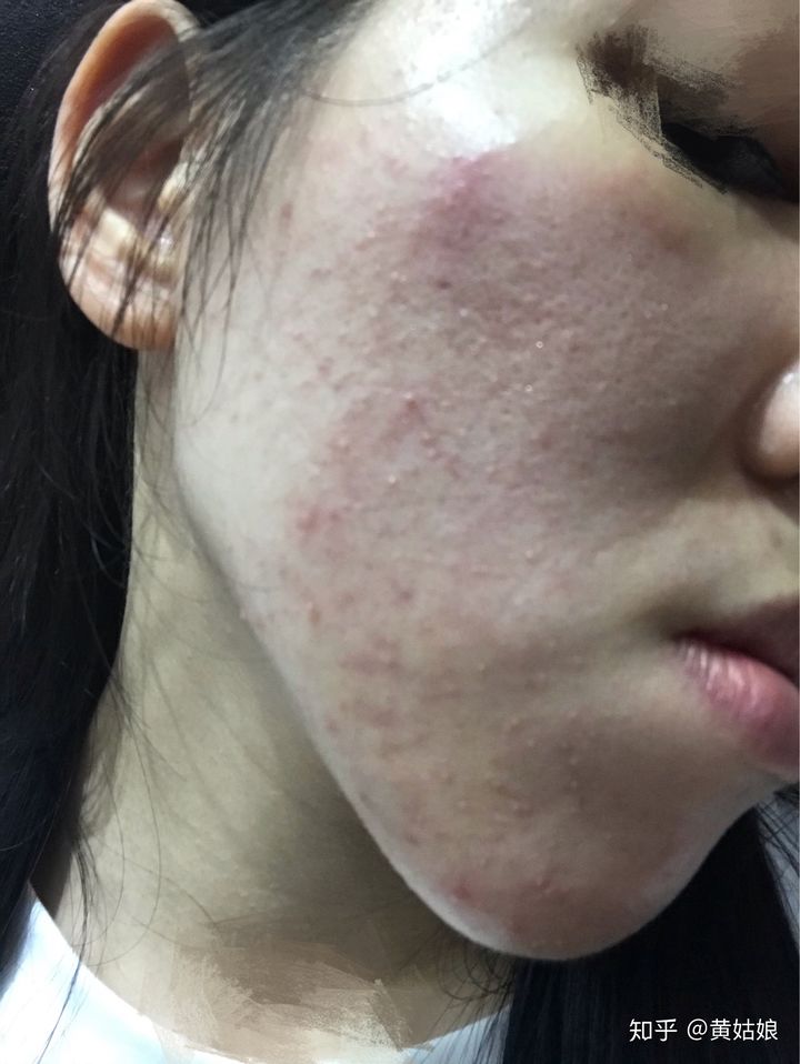 亲身经历治疗痤疮偏方_治痤疮偏方绝招_痤疮小偏方