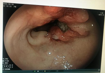 胃穿孔手术_胃后壁穿孔胃内容物将流向_耳鼓膜穿孔手术需要住院么