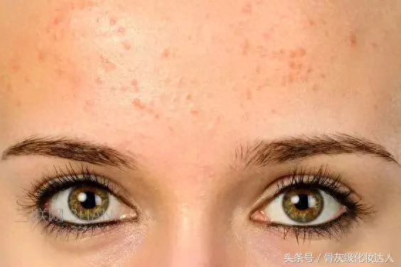晒斑会自己消退吗_晒斑怎么快速去除_日晒斑