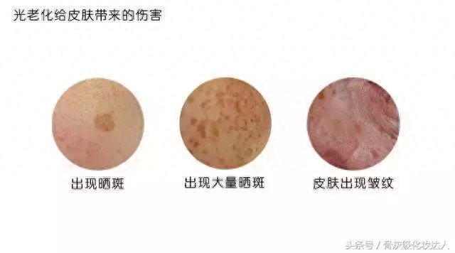 晒斑怎么快速去除_晒斑会自己消退吗_日晒斑