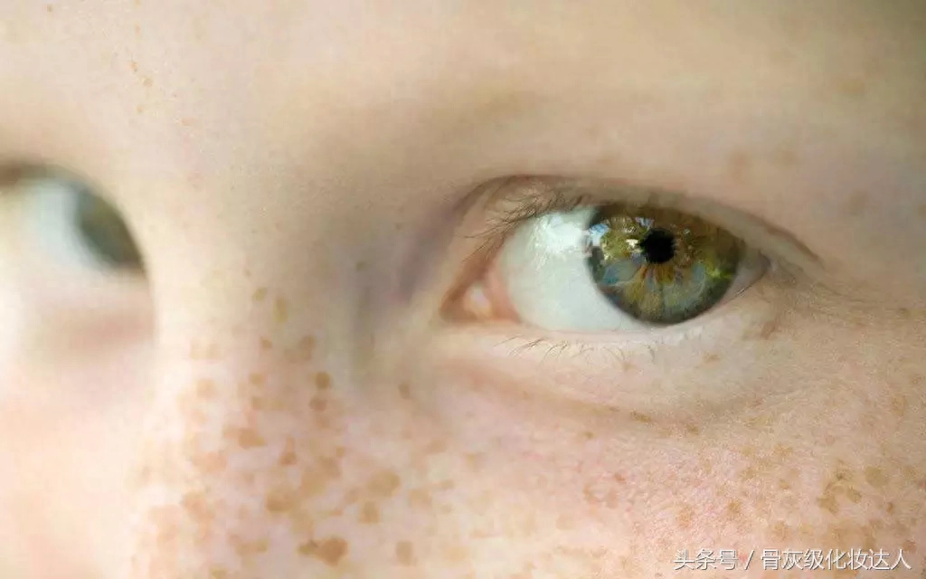 日晒斑_晒斑怎么快速去除_晒斑会自己消退吗