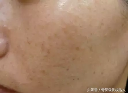 日晒斑_晒斑怎么快速去除_晒斑会自己消退吗