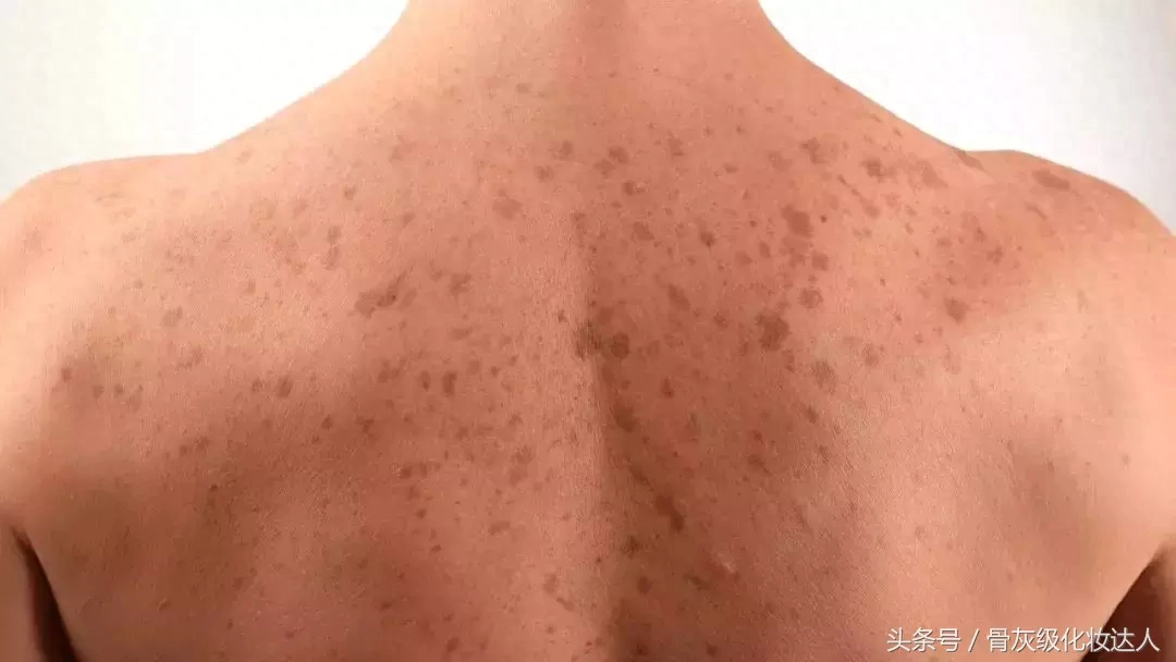 晒斑会自己消退吗_日晒斑_晒斑怎么快速去除