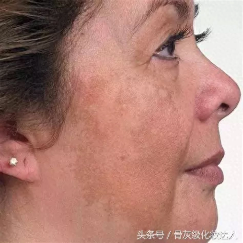 晒斑怎么快速去除_日晒斑_晒斑会自己消退吗