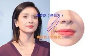 自体脂肪填充苹果肌_苹果肌_苹果肌