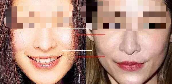 自体脂肪填充苹果肌_苹果肌_苹果肌