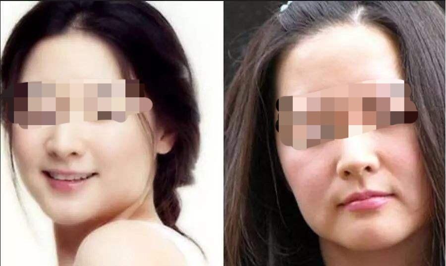 苹果肌_自体脂肪填充苹果肌_苹果肌