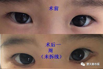 毛囊炎偏方_生姜治疗毛囊炎的偏方_治疗毛囊炎的偏方