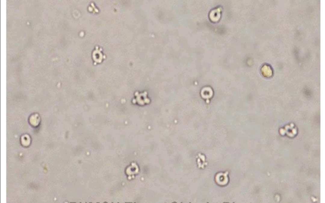 血尿可能原因_血尿因为什么_血尿的原因