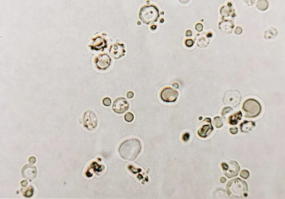 血尿的原因_血尿因为什么_血尿可能原因