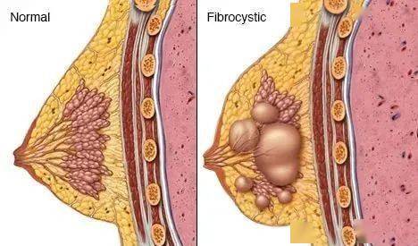 治疗乳腺增生的民间偏方_有治疗乳腺增生的偏方吗_乳腺增生有什么偏方可以根治