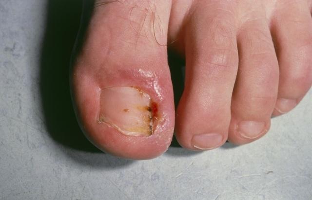 脚趾甲沟炎怎么治疗_脚趾甲沟炎怎么办_大脚趾甲沟炎隆起图片