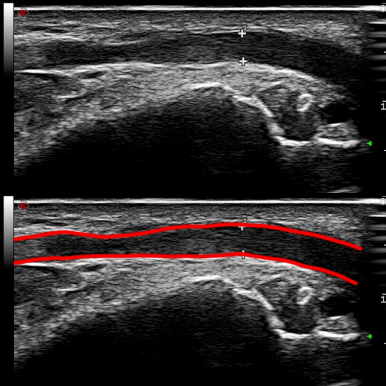 小拇指发麻_手指拇指麻_拇指手麻