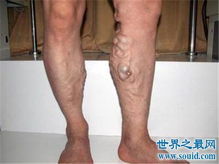 治疗静脉曲张的偏方 看完值得试试(www.souid.com)