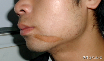 什么样的疤痕是增生疤痕_疤痕_疤痕种植整形疤痕整形