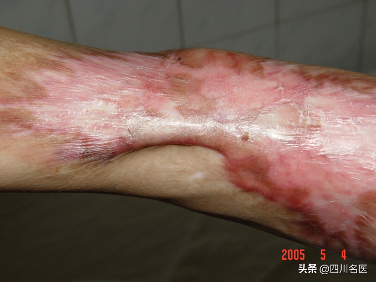 疤痕_什么样的疤痕是增生疤痕_疤痕种植整形疤痕整形