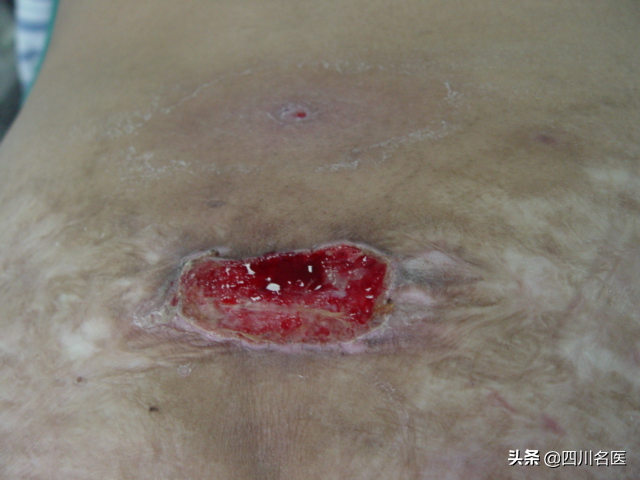 疤痕种植整形疤痕整形_什么样的疤痕是增生疤痕_疤痕