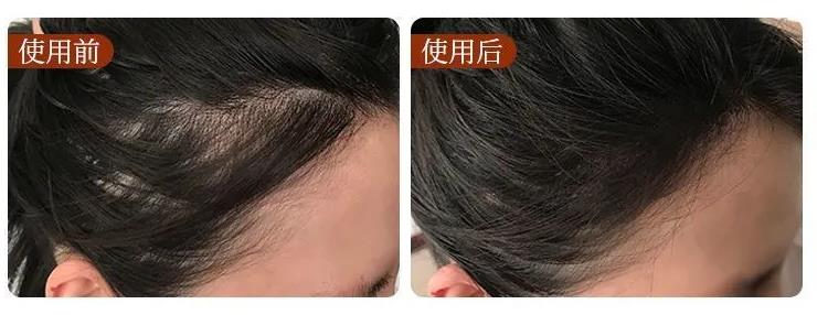 防脱发的偏方_肾虚脱发偏方_男生玄处脱发原因及治疗偏方