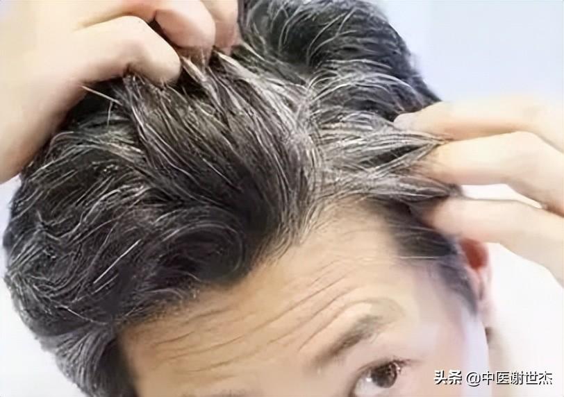 治疗白发的偏方_治疗白发偏方大全_治疗两鬓白发偏方