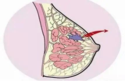 乳腺导管癌是什么症状_乳腺癌的中期症状_胃病综合症中期症状有哪些症状