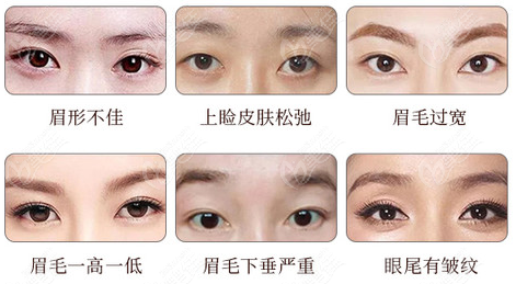 六种常见需要做切眉术的眉眼类型