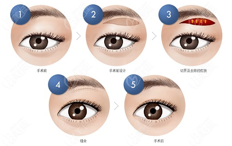 切眉手术动画示意图