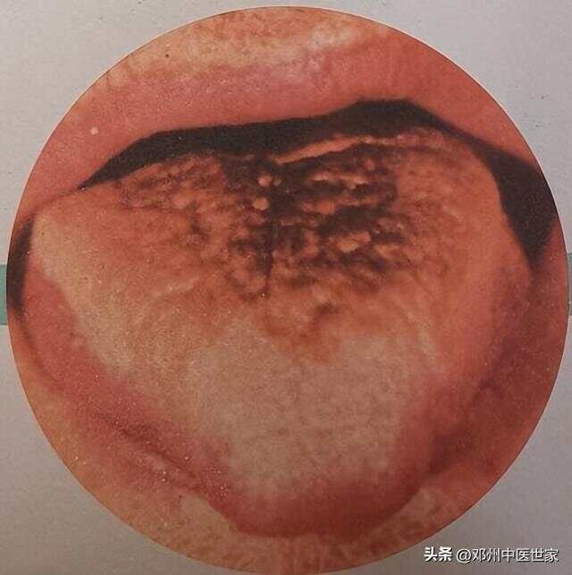黑色舌苔的中医治疗验案