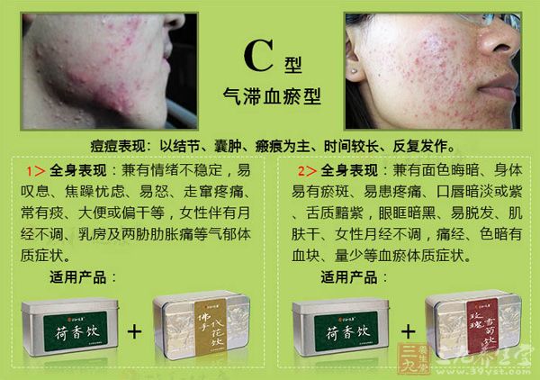 中药祛痘种外敷偏方有哪些_中药祛痘外敷偏方7种中药_中药祛痘外敷偏方大全
