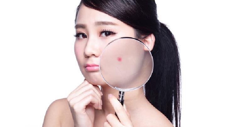 常见的中医祛痘偏方有哪些？中医如何祛痘？