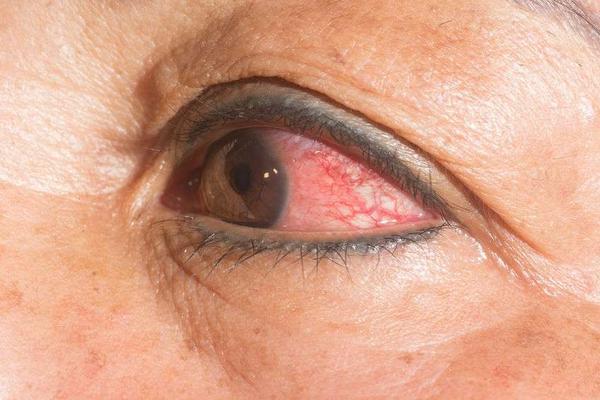 眼白有血丝_眼白布满血丝_眼白有血丝会自己消失吗