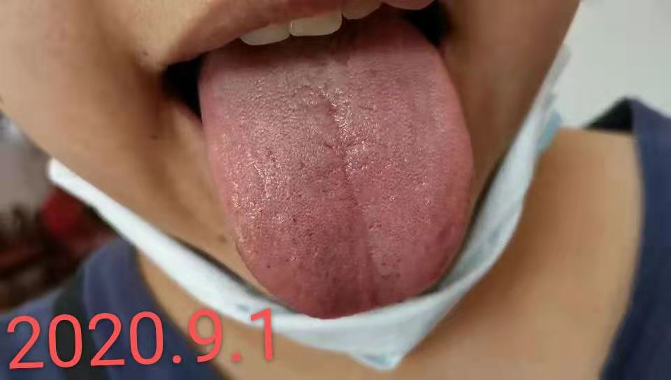 舌裂纹是什么原因_舌裂纹严重怎么治疗_裂纹舌