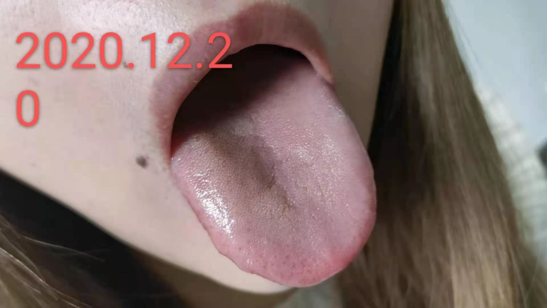 裂纹舌_舌裂纹严重怎么治疗_舌裂纹是什么原因