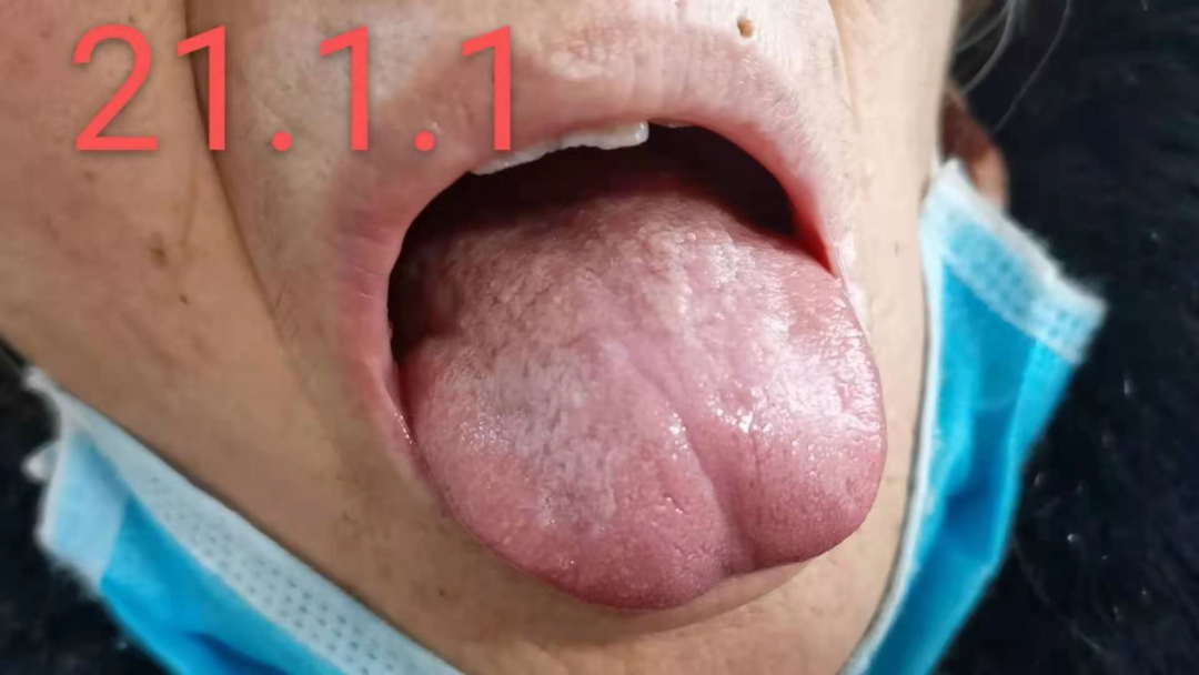 裂纹舌_舌裂纹严重怎么治疗_舌裂纹是什么原因