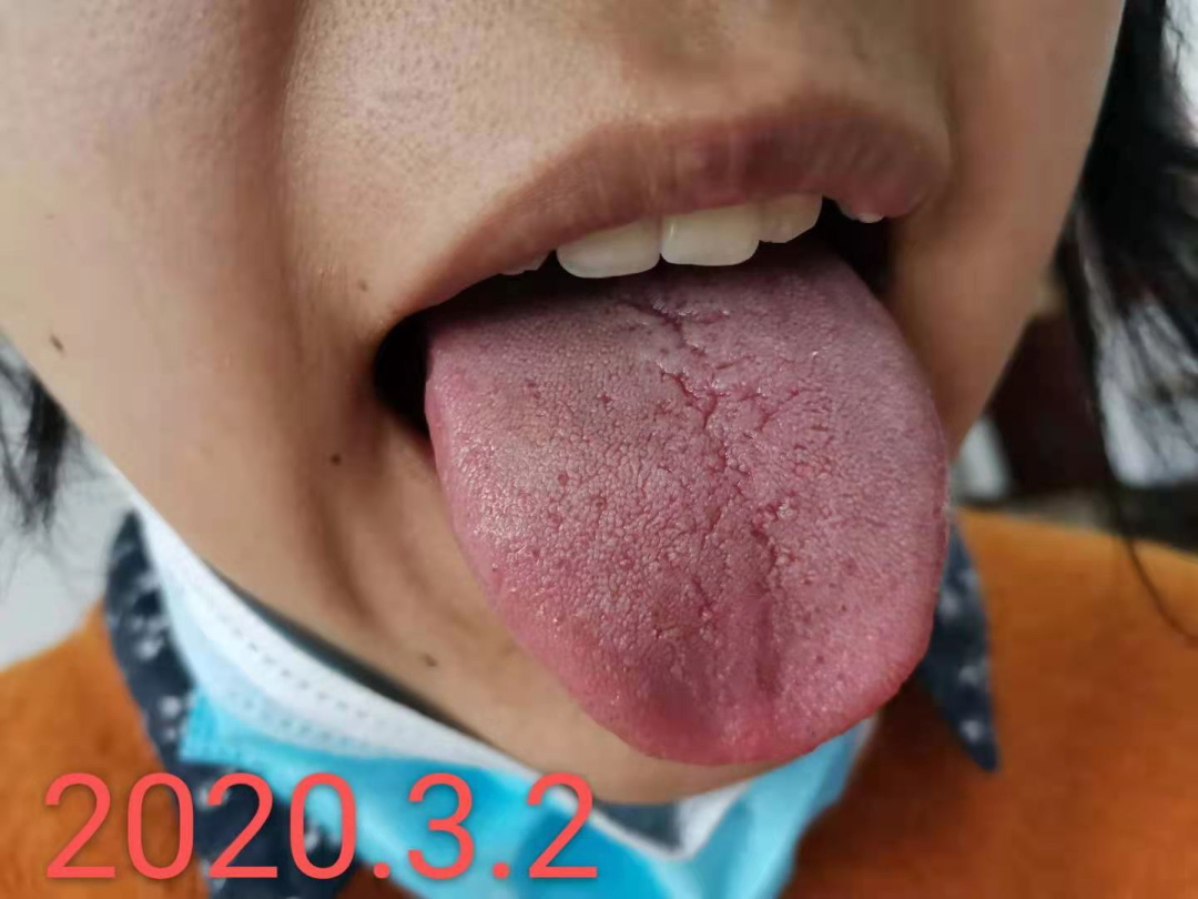 舌裂纹严重怎么治疗_裂纹舌_舌裂纹是什么原因