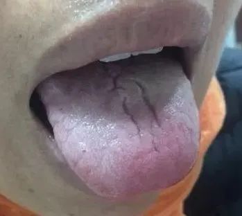 舌裂纹的原因_裂纹舌_舌裂纹是什么原因